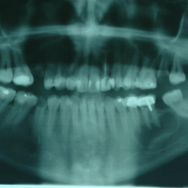 Αρχική ακτινογραφία στο οδοντιατρείο