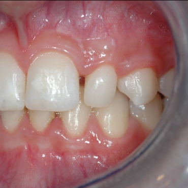 Pre treatment left lateral incisor