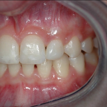 Post treatment left lateral incisor