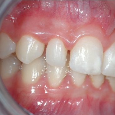 Pre treatment right lateral incisor