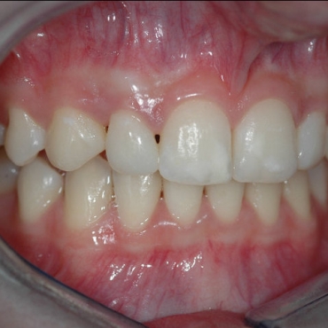 Post treatment right lateral incisor