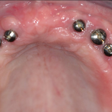 6 implants in the maxilla with the healing abutments