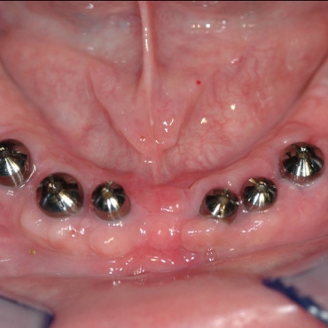 8 implants in the mandibula with the healing abutments
